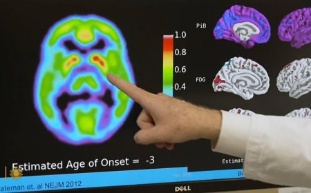 Promising clinical trials in Alzheimer's prevention